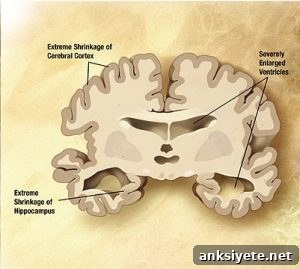 The image shows damage to the brain in an Alzheimer's patient.