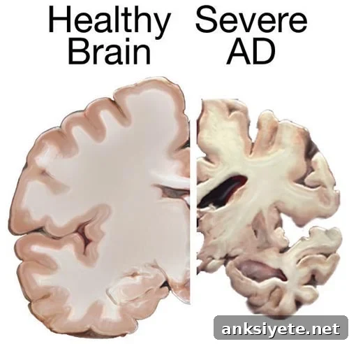 The image shows a normal brain slice and a brain slice of with severe AD.