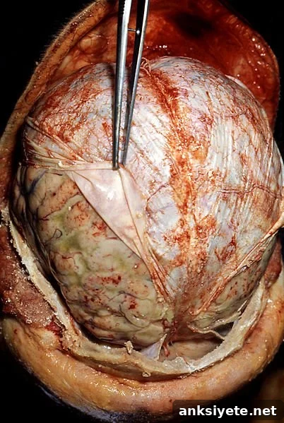 Induced Hypothermia Raises Risk in Severe Bacterial Meningitis 2 Autopsy image of a brain with meningitis