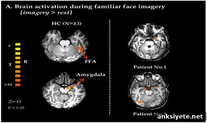 This is an fMRI of a patient in a vegetative state.