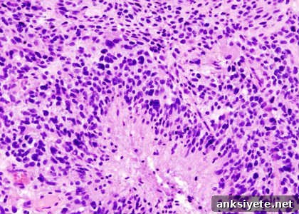 Histopathological image of cerebral glioblastoma. Hematoxylin & esoin stain.