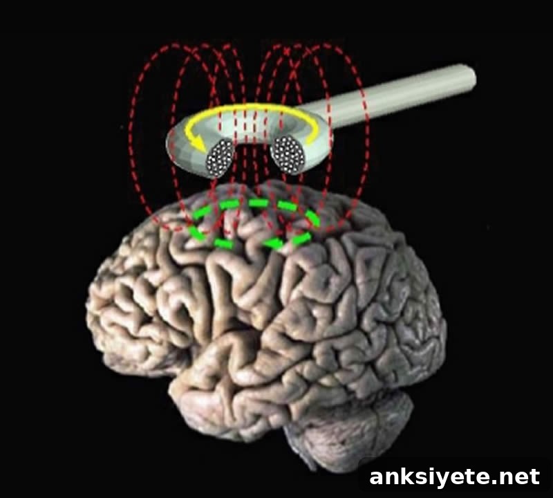 The image shows a brain with a diagram of a TMS machine placed above it.