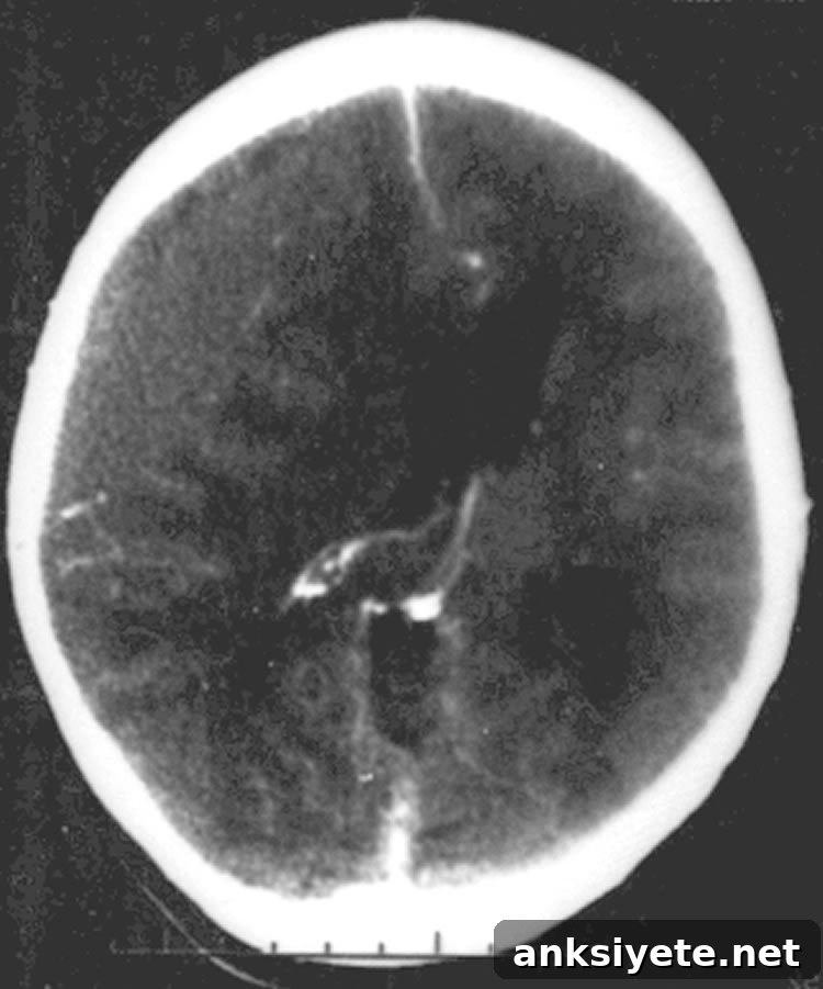 This image shows a CT scan of a epidural hematoma.