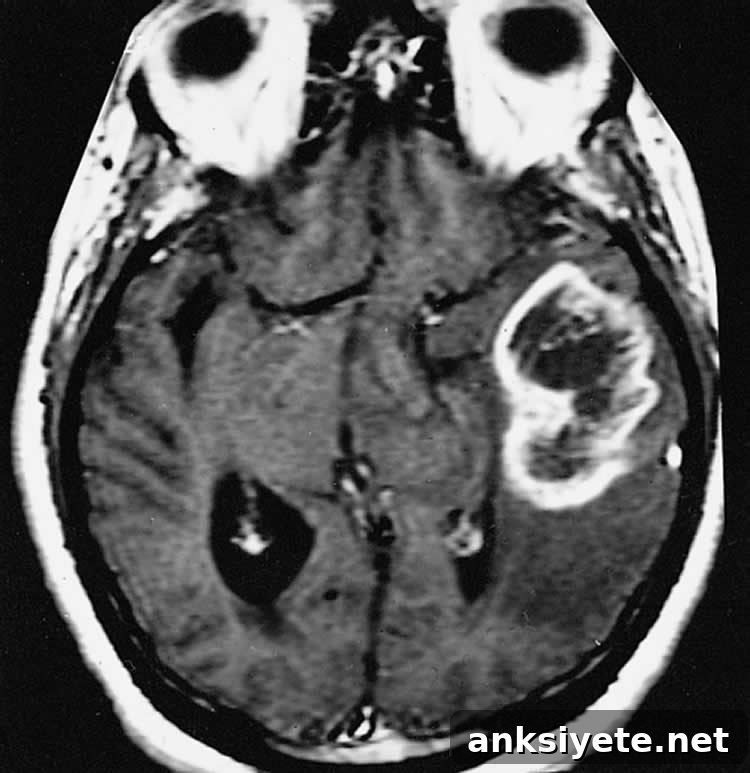 This image shows an MRI brain scan of a person with glioblastoma brain cancer.