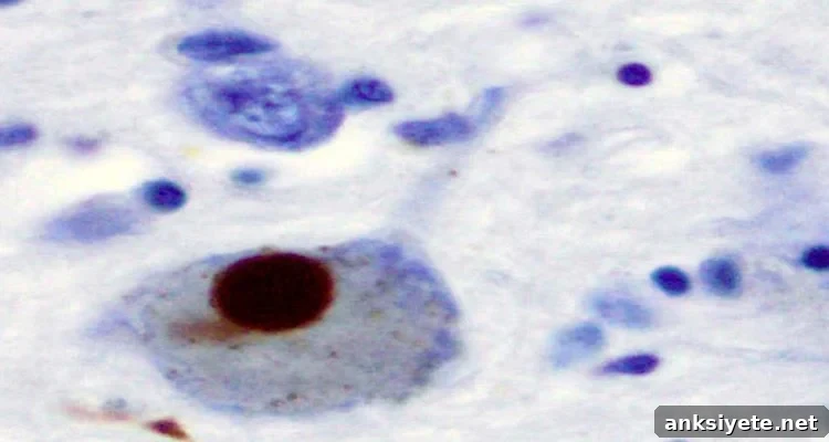 This shows immunohistochemistry for alpha-synuclein showing positive staining (brown) of an intraneural Lewy-body in the Substantia nigra in Parkinson's disease.