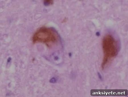 Microscopic image of Lewy bodies