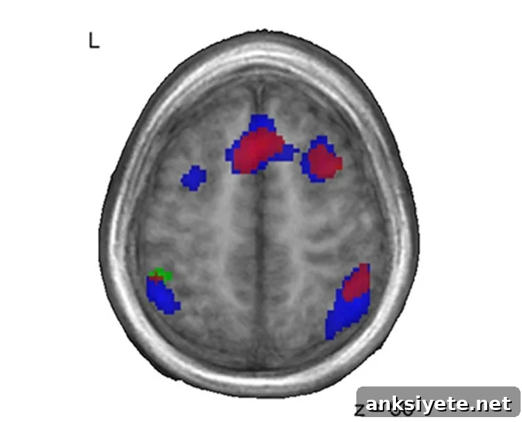 Brain scan showing different areas activated by bilingual and unilingual speakers.