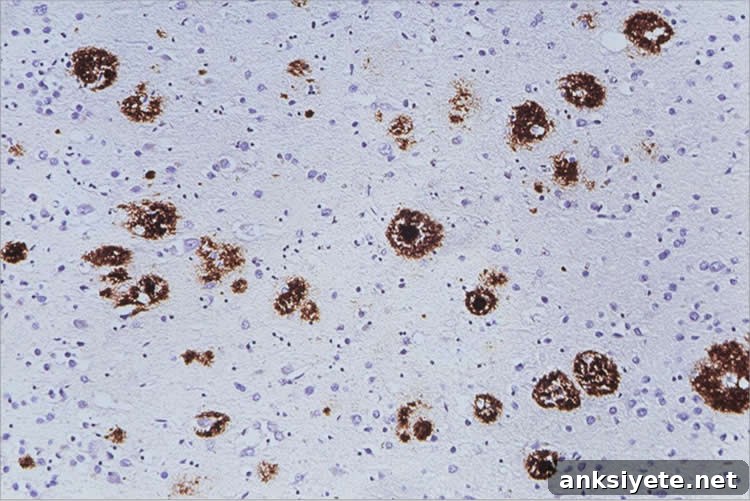 Image shows amyloid beta in the cerebral cortex.