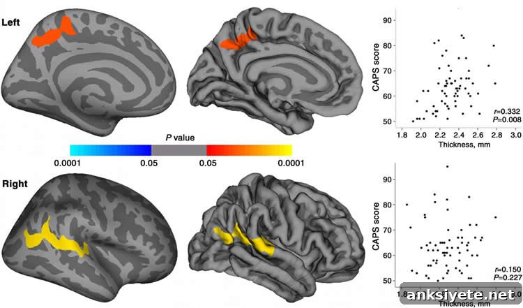 PTSD Neuroimaging Reveals Brain Changes in Earthquake Survivors 2 Image shows brain scans with the cortical thickness mapped.