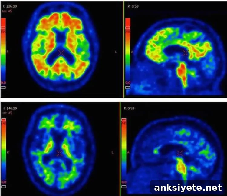 PET scans show AB spots in the brain of an Alzheimer's patient.