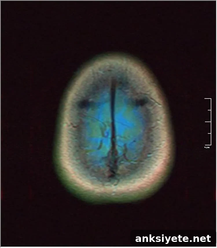 Image shows brain scan of glioma.