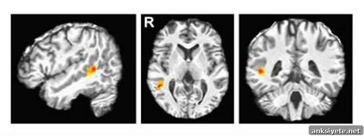 Image shows a brain scan with the pSTS highlighted.