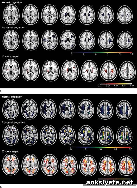 MRI scans mapping ischemic lesions