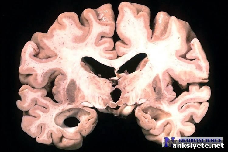 Image shows an alzheimer's brain slice.