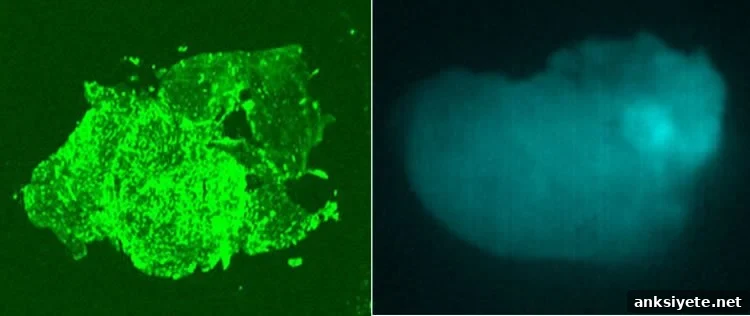 Tumor Paint Lights Up Toddler's Brain Tumor During Surgery 2 Pathology image of Hunter’s tumor glowing with BLZ-100 Tumor Paint and an intraoperative view of the tumor glow.