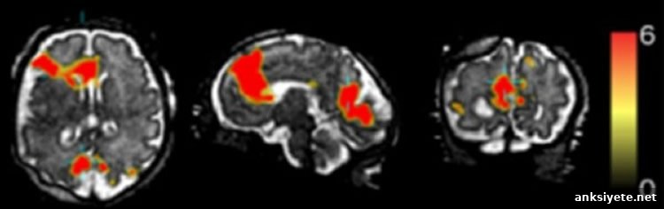 Image shows an MRI of a fetal brain.