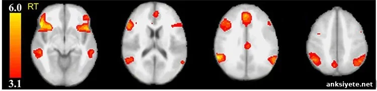 Image shows brain scans.