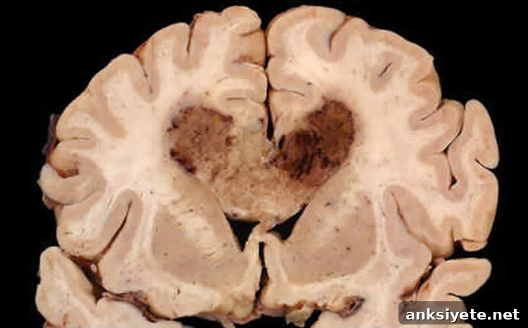 Image shows a brain slice with a glioblastoma brain tumor.