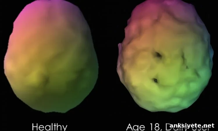 Brain SPECT scans comparing a healthy control and a daily marijuana user, age 18