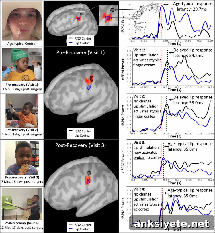 Image shows how the brain remapped itself.
