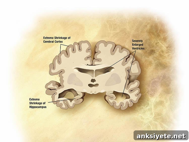 alzheimer's brain