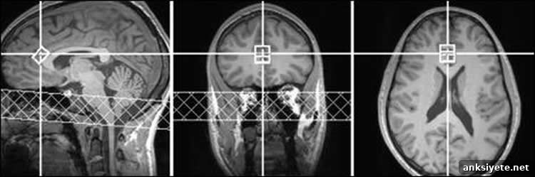 brain scan