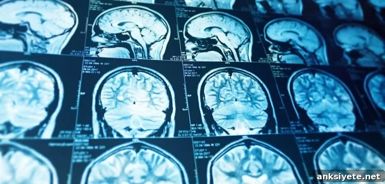 Study Finds Known Stroke Risk Genes Have Tripled 2 brain scan