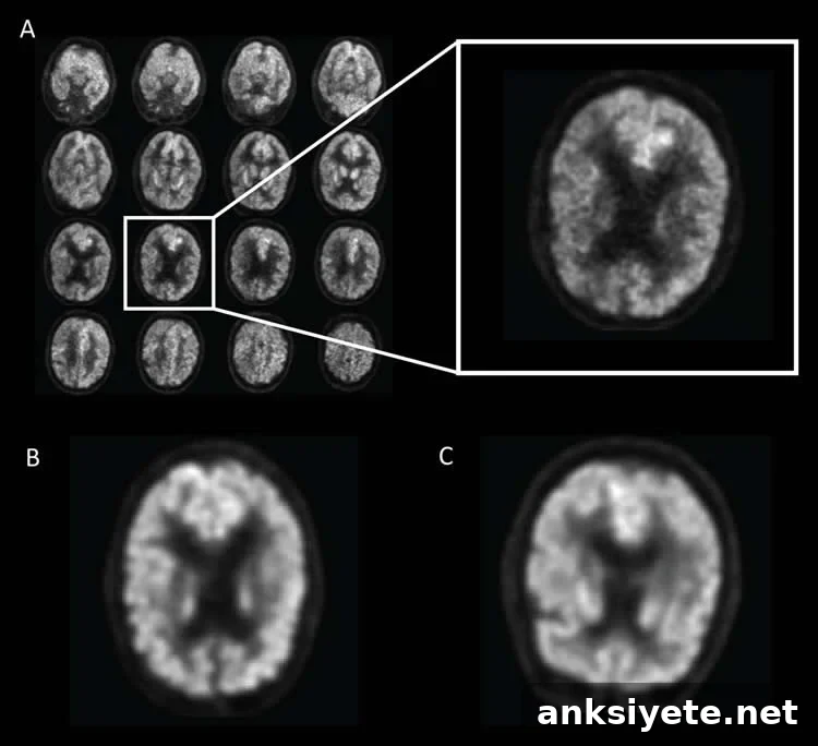 AI Predicts Alzheimer’s Years Before Clinical Diagnosis 2 brain scans of Alzheimer's patients
