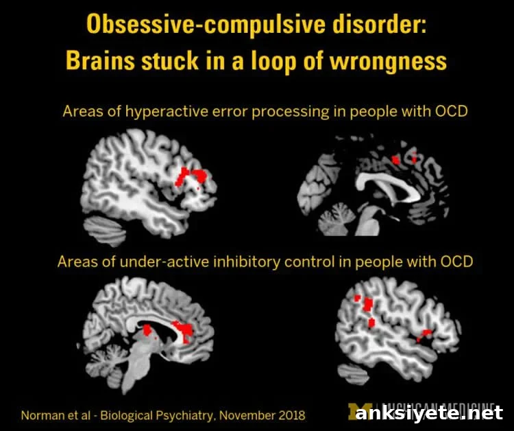 brain scans of ocd patients