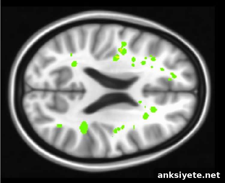 sickle cell brain scan