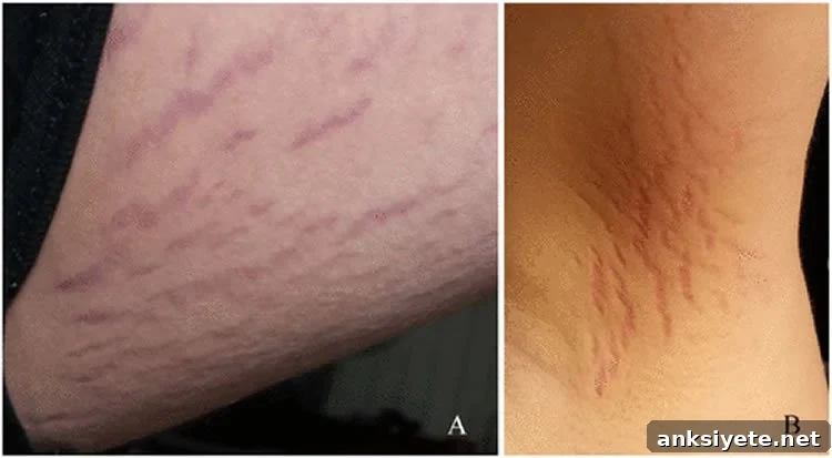 this shows how the bartonella infection looks on the skin