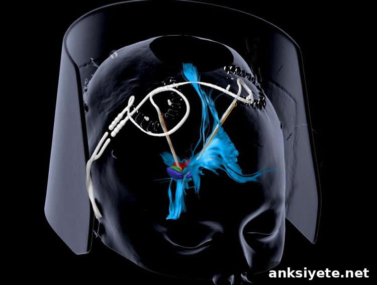 diagram of DBS implants in the brain