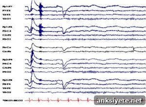 EEG trace patterns.