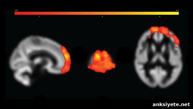 This shows brain scans from the study