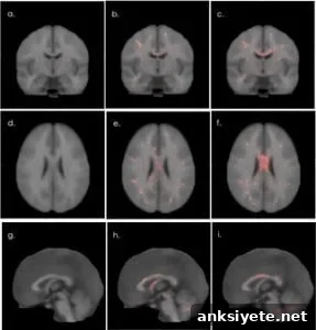 The image shows comparative brain scans of veterans with mild TBI and those without TBI.