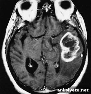 The image shows an MRI scan of a glioblastoma multiforme in a human brain.