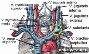 Diagram of veins in the neck affected by CCSVI