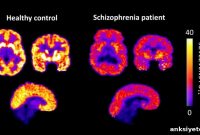 Widespread M1 Receptor Deficits Linked to Schizophrenia